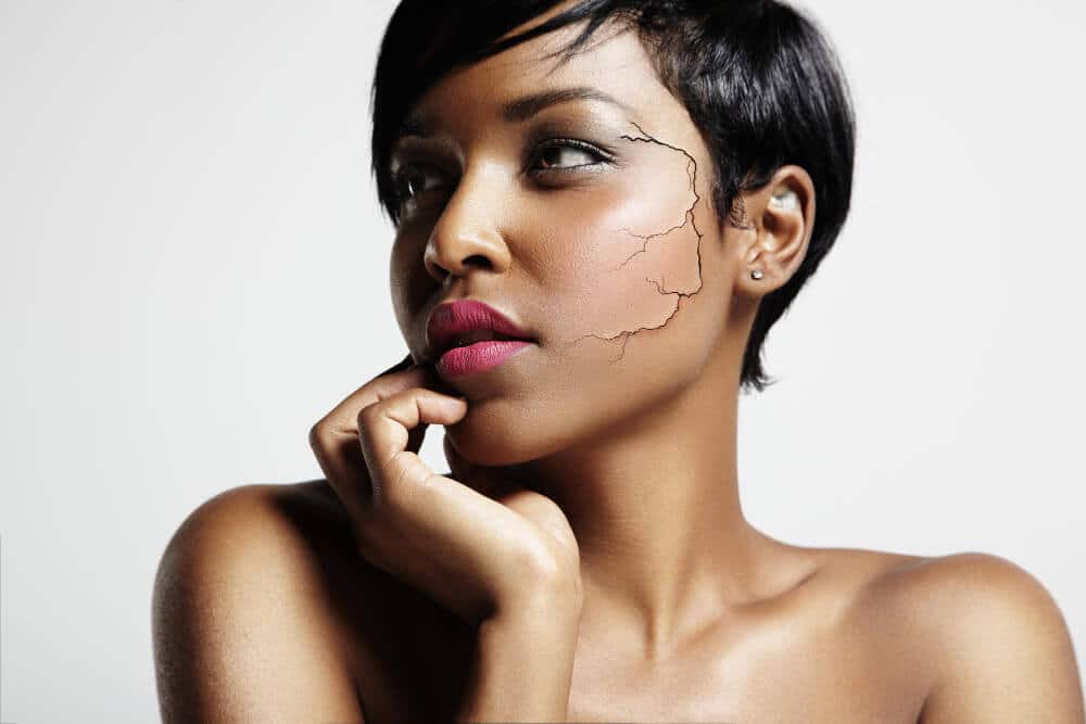 קרם פנים לעור יבש מאמר | pretty-black-woman-with-cracked-skin-face (1)